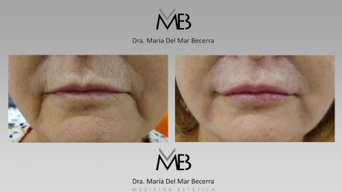 Rejuvenecimiento Peribucal